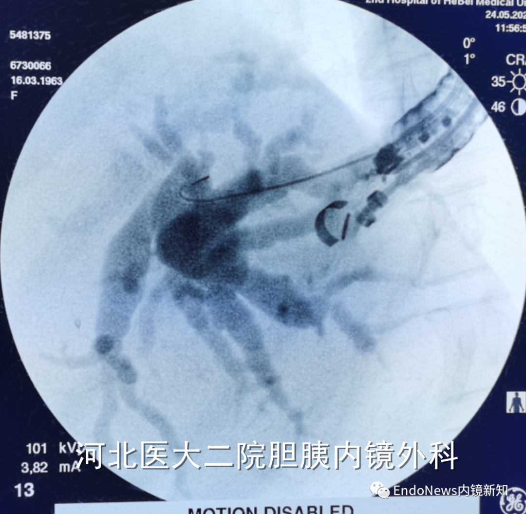取石网篮 为什么贵EUS-BD操作中的细节：导丝如何超选？_https://www.jmylbn.com_新闻资讯_第24张