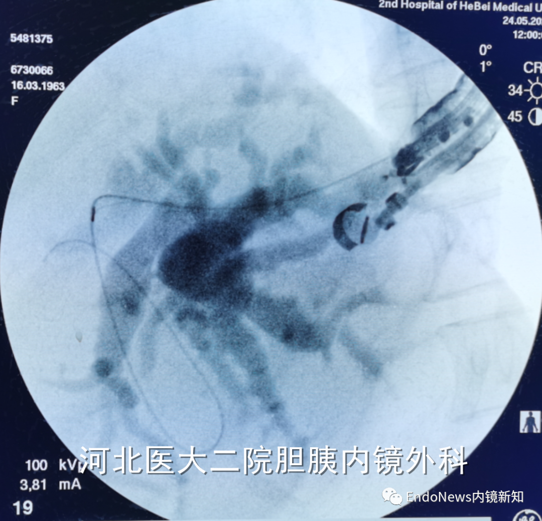 取石网篮 为什么贵EUS-BD操作中的细节：导丝如何超选？_https://www.jmylbn.com_新闻资讯_第30张