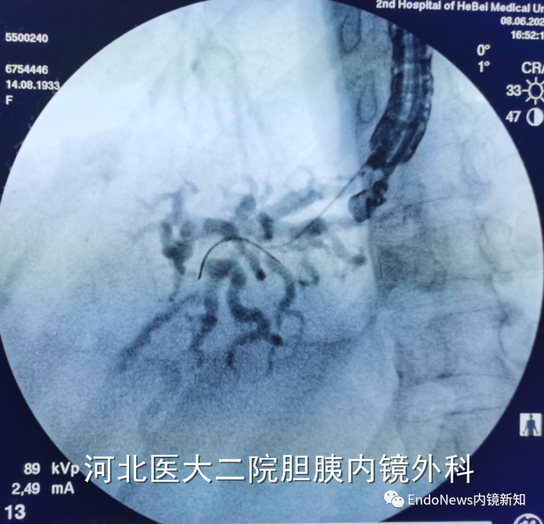取石网篮 为什么贵EUS-BD操作中的细节：导丝如何超选？_https://www.jmylbn.com_新闻资讯_第13张