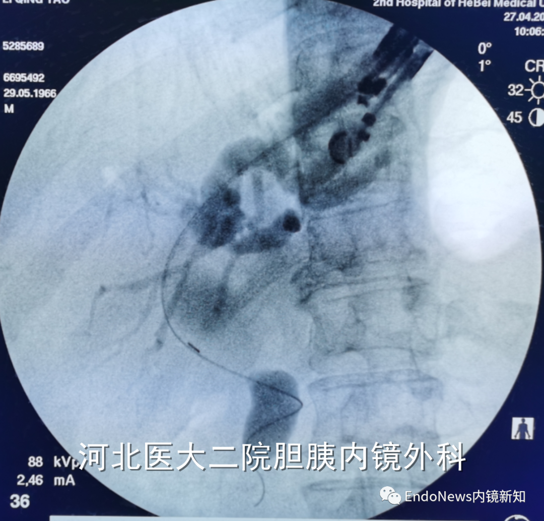 取石网篮 为什么贵EUS-BD操作中的细节：导丝如何超选？_https://www.jmylbn.com_新闻资讯_第43张