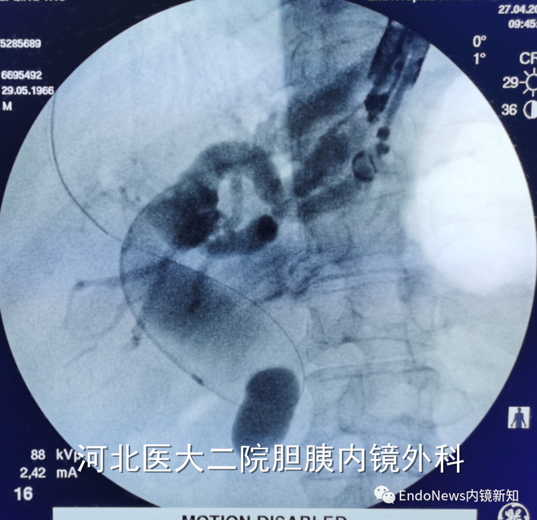 取石网篮 为什么贵EUS-BD操作中的细节：导丝如何超选？_https://www.jmylbn.com_新闻资讯_第33张