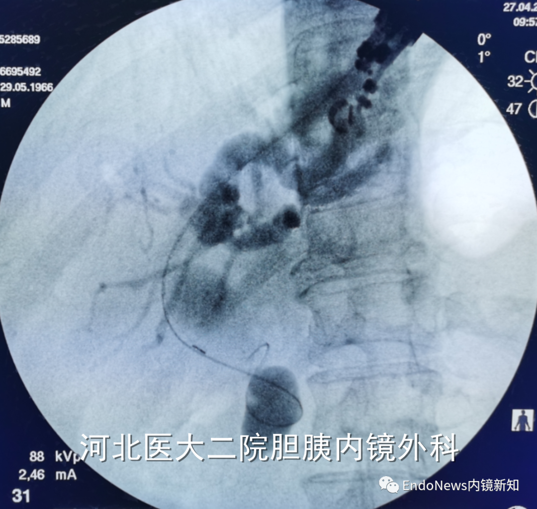 取石网篮 为什么贵EUS-BD操作中的细节：导丝如何超选？_https://www.jmylbn.com_新闻资讯_第39张