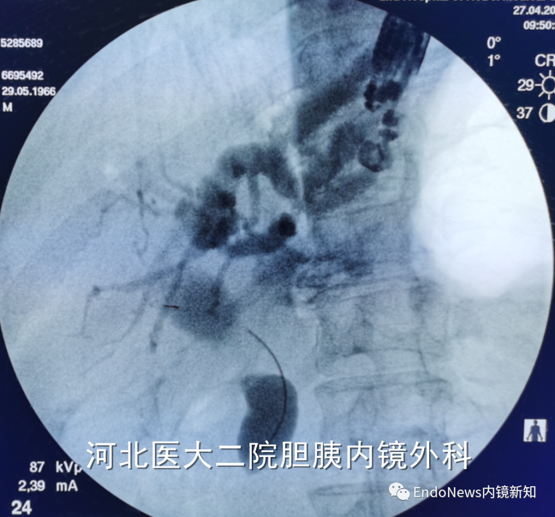 取石网篮 为什么贵EUS-BD操作中的细节：导丝如何超选？_https://www.jmylbn.com_新闻资讯_第35张
