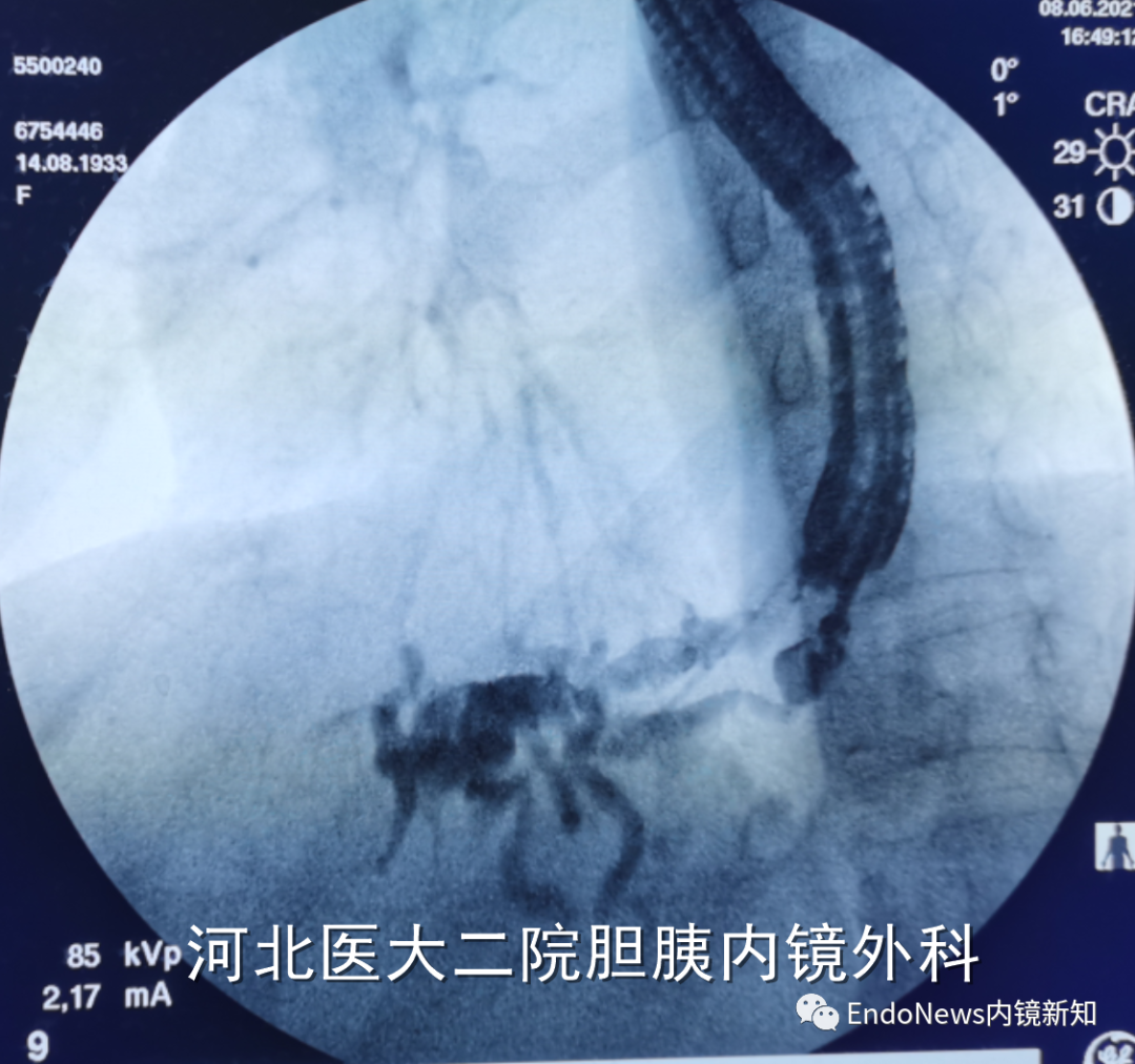 取石网篮 为什么贵EUS-BD操作中的细节：导丝如何超选？_https://www.jmylbn.com_新闻资讯_第9张