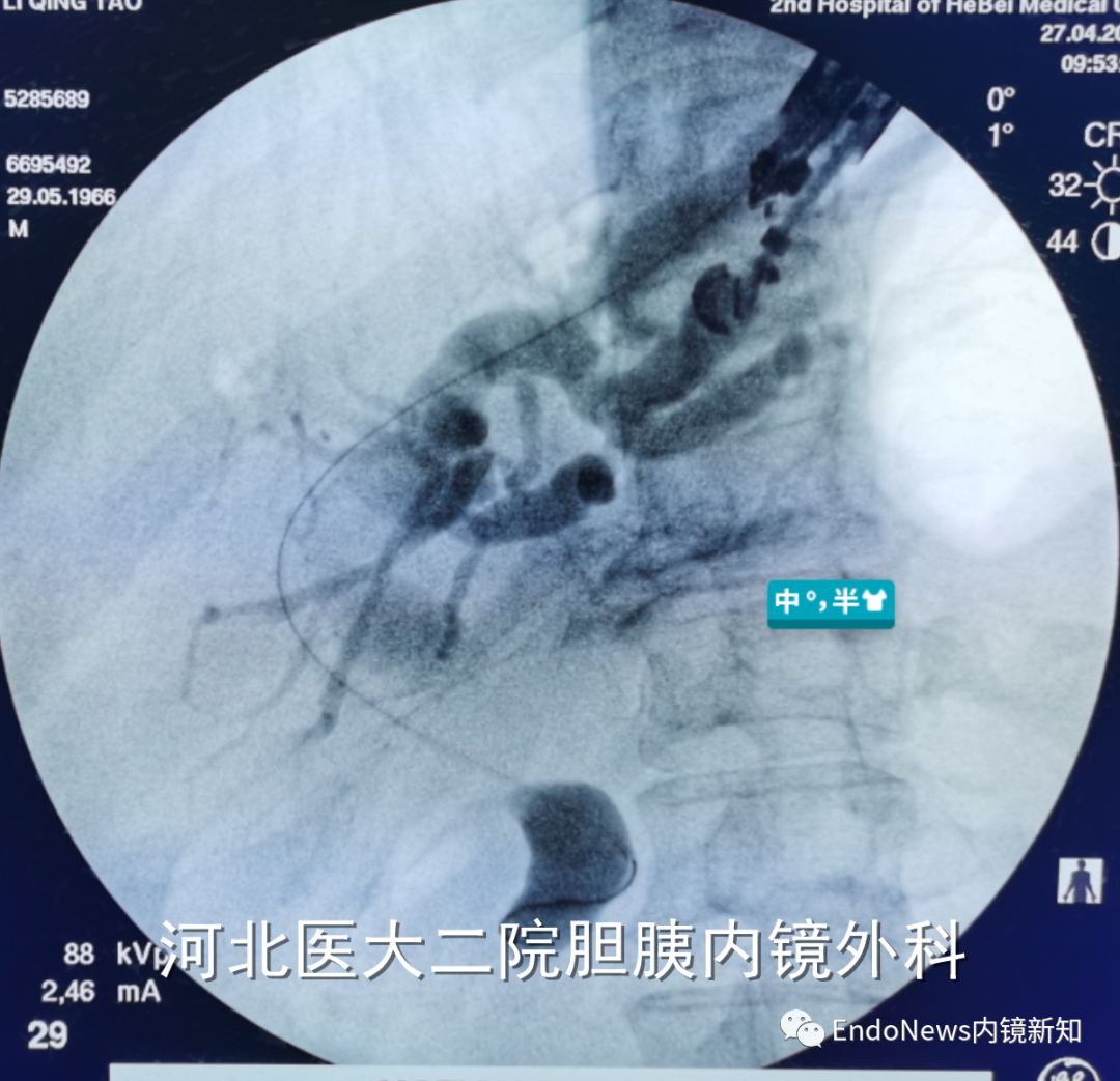 取石网篮 为什么贵EUS-BD操作中的细节：导丝如何超选？_https://www.jmylbn.com_新闻资讯_第37张
