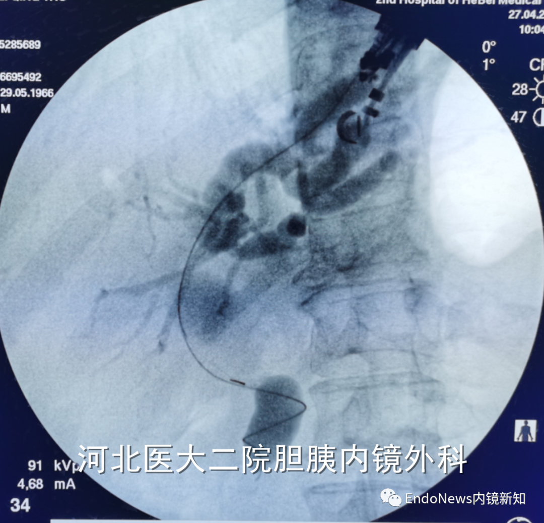 取石网篮 为什么贵EUS-BD操作中的细节：导丝如何超选？_https://www.jmylbn.com_新闻资讯_第41张