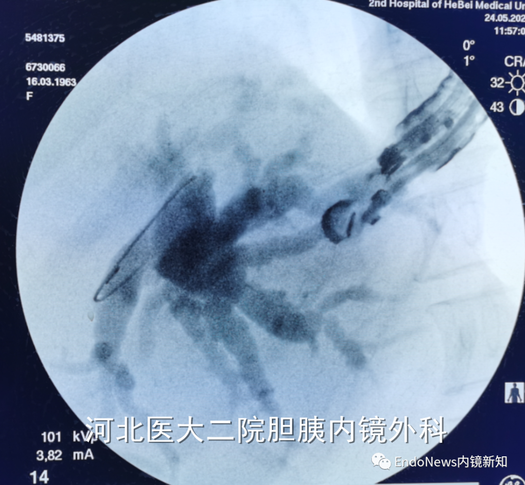 取石网篮 为什么贵EUS-BD操作中的细节：导丝如何超选？_https://www.jmylbn.com_新闻资讯_第25张