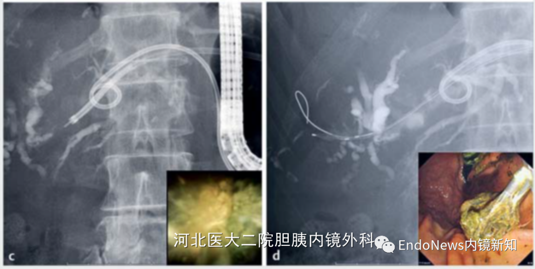 取石网篮 为什么贵EUS-BD操作中的细节：导丝如何超选？_https://www.jmylbn.com_新闻资讯_第17张