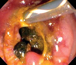 取石球囊怎么使用取石球囊被卡住？ERCP治疗胆总管结石一例罕见并发症_https://www.jmylbn.com_新闻资讯_第6张