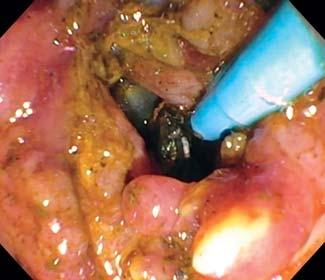 取石球囊怎么使用取石球囊被卡住？ERCP治疗胆总管结石一例罕见并发症_https://www.jmylbn.com_新闻资讯_第7张
