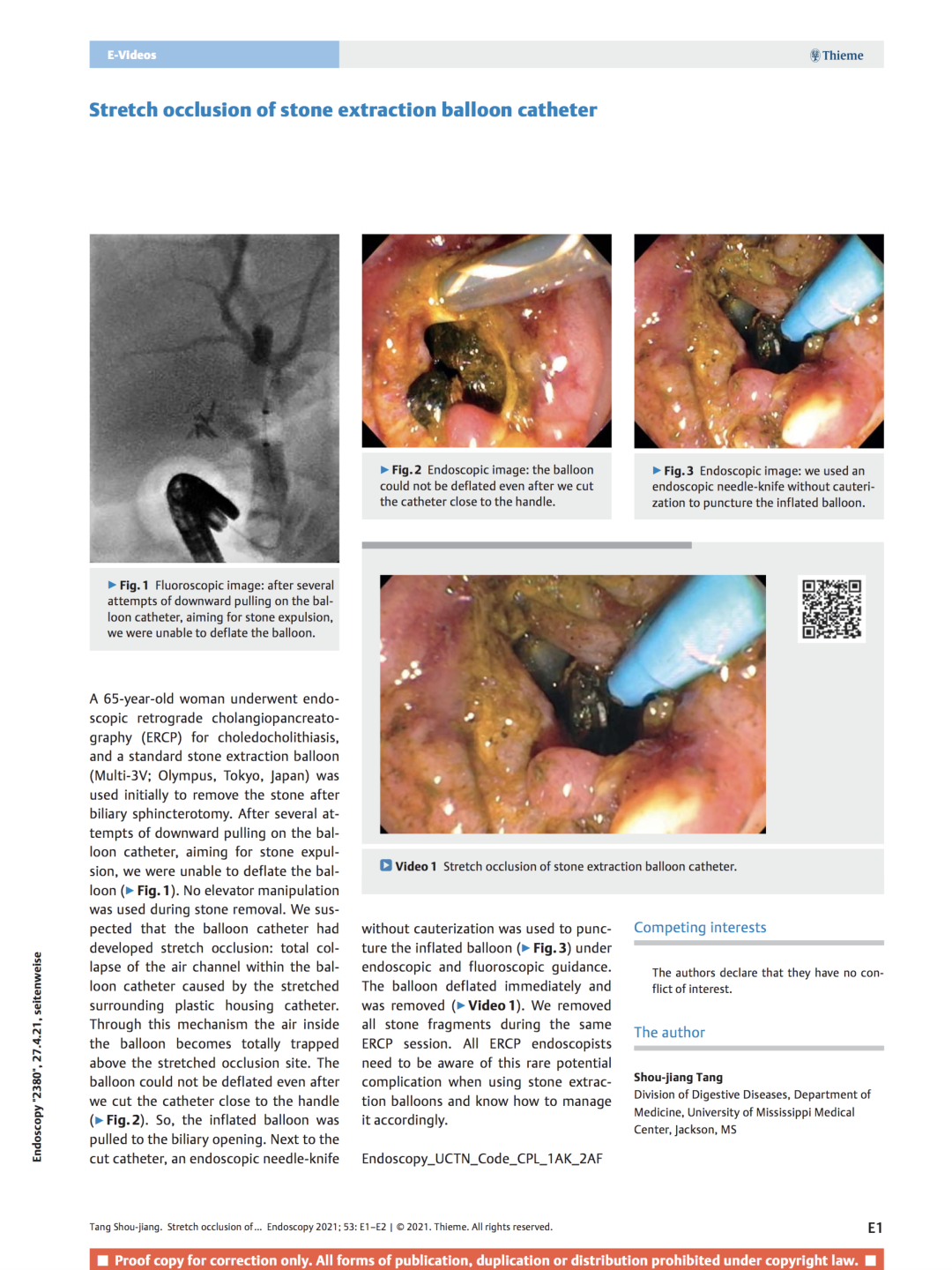 取石球囊怎么使用取石球囊被卡住？ERCP治疗胆总管结石一例罕见并发症_https://www.jmylbn.com_新闻资讯_第3张