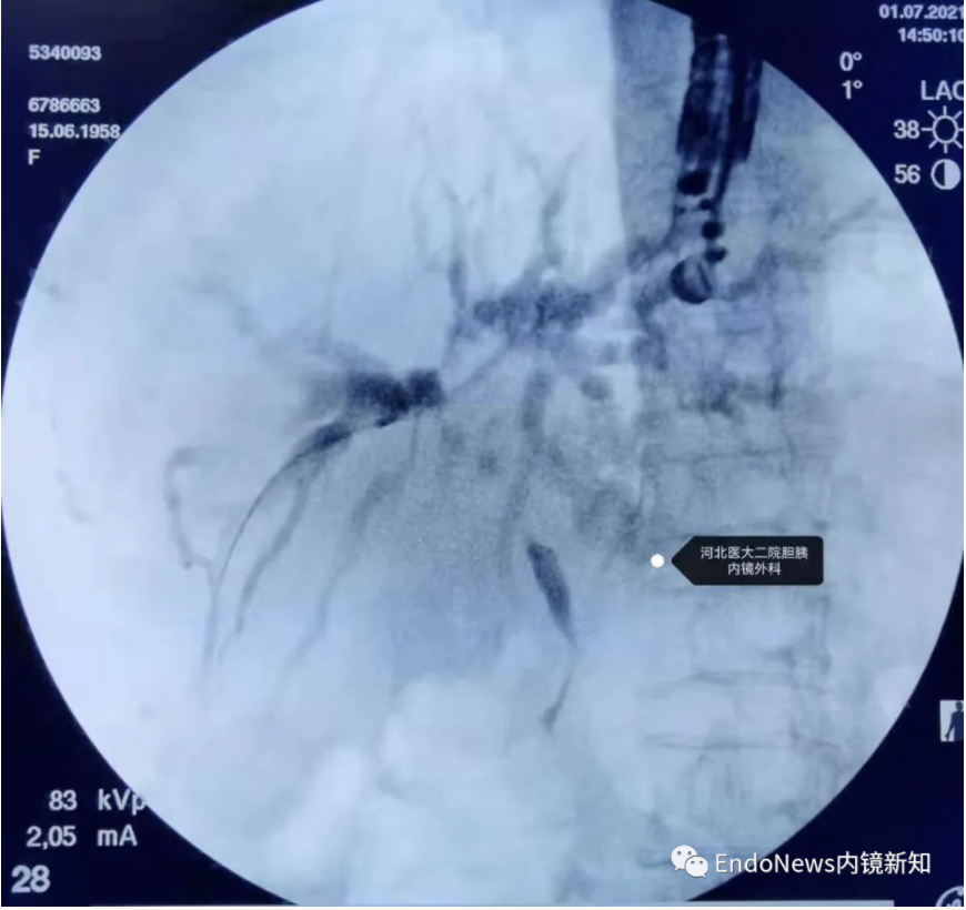 取石网篮 为什么贵EUS-BD操作中的细节：导丝如何超选？_https://www.jmylbn.com_新闻资讯_第15张