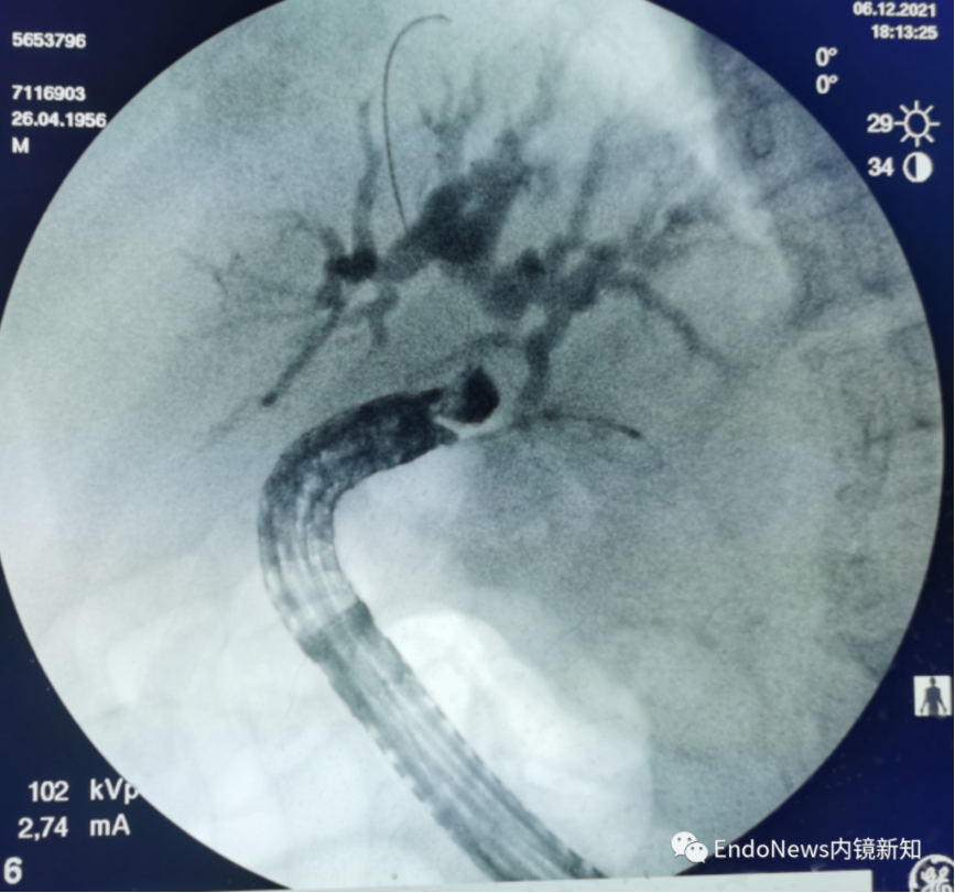 取石网篮 为什么贵EUS-BD操作中的细节：导丝如何超选？_https://www.jmylbn.com_新闻资讯_第4张
