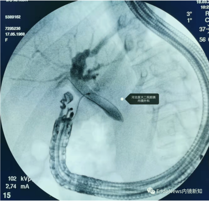 取石网篮 为什么贵EUS-BD操作中的细节：导丝如何超选？_https://www.jmylbn.com_新闻资讯_第5张