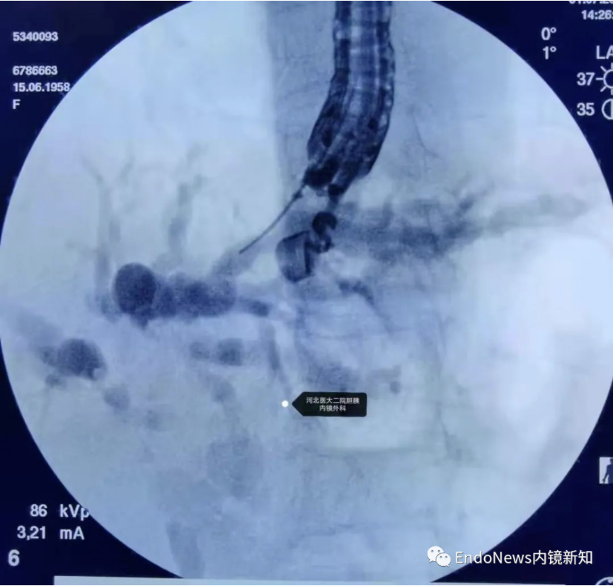 取石网篮 为什么贵EUS-BD操作中的细节：导丝如何超选？_https://www.jmylbn.com_新闻资讯_第14张