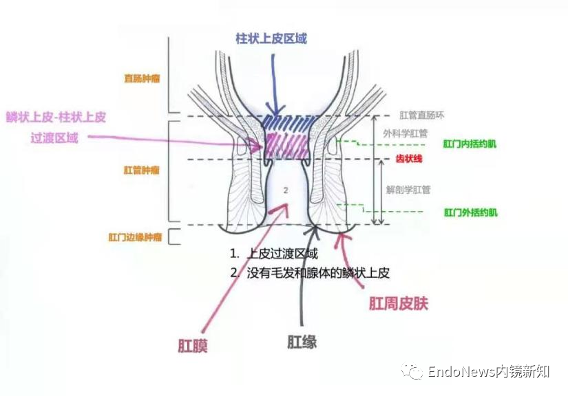 乾貨總結經內鏡痔上直腸黏膜套扎的再認識