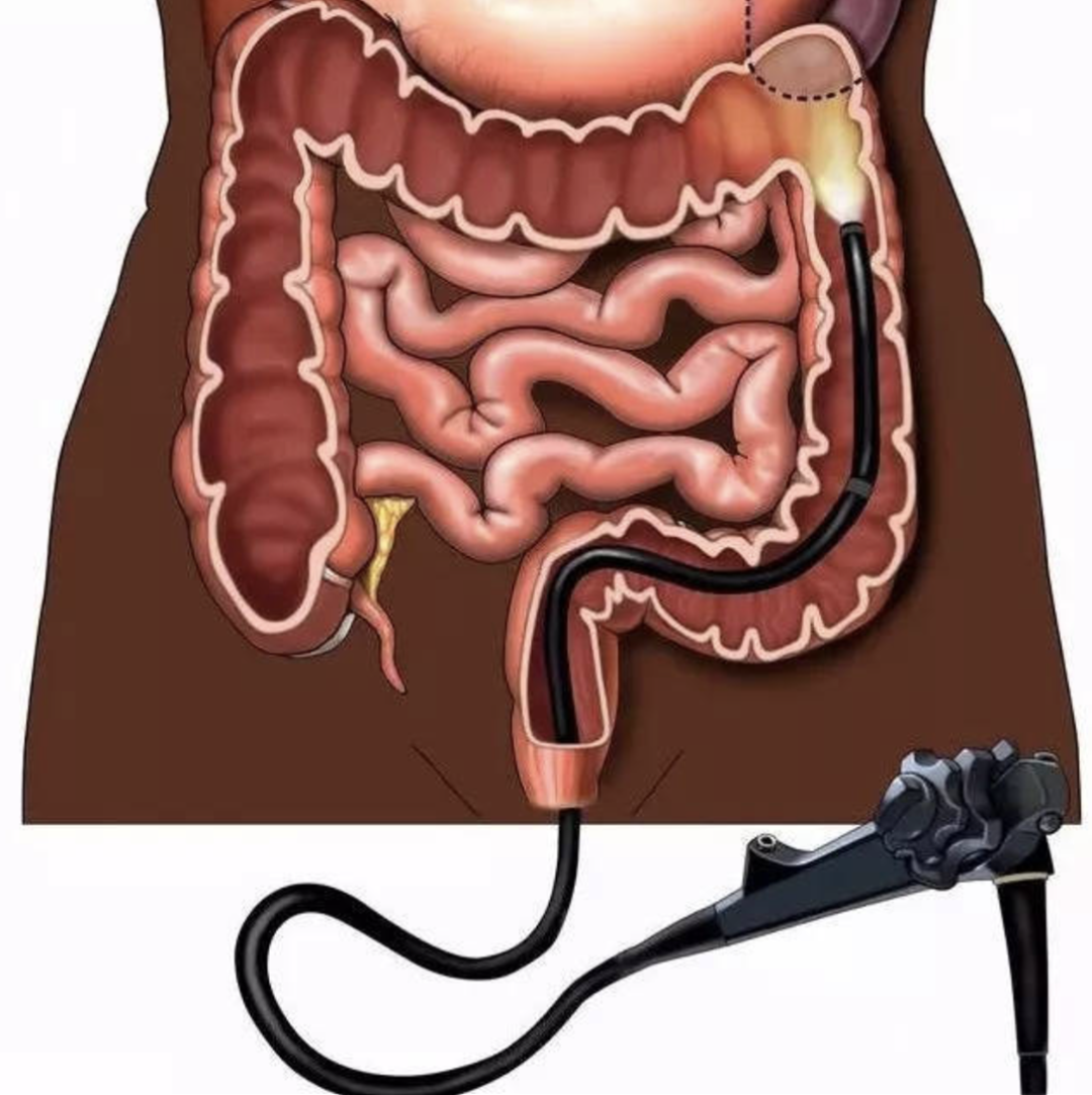 为什么活检钳不是一次性肠镜单人活检技术的操作要点_https://www.jmylbn.com_新闻资讯_第2张