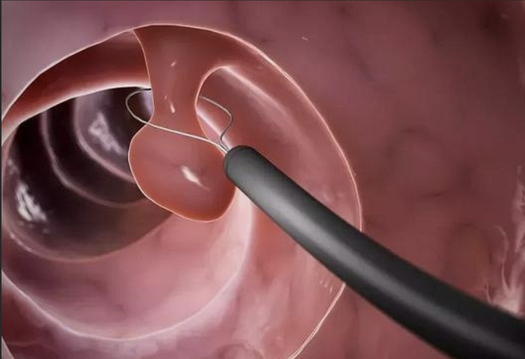 为什么活检钳不是一次性肠镜单人活检技术的操作要点_https://www.jmylbn.com_新闻资讯_第3张