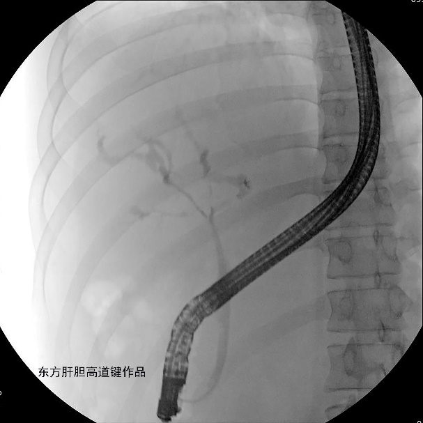 胆管支架什么样子内镜下三金属支架置入术治疗肝门胆管恶性狭窄_https://www.jmylbn.com_新闻资讯_第3张
