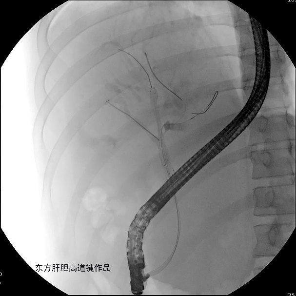 胆管支架什么样子内镜下三金属支架置入术治疗肝门胆管恶性狭窄_https://www.jmylbn.com_新闻资讯_第8张