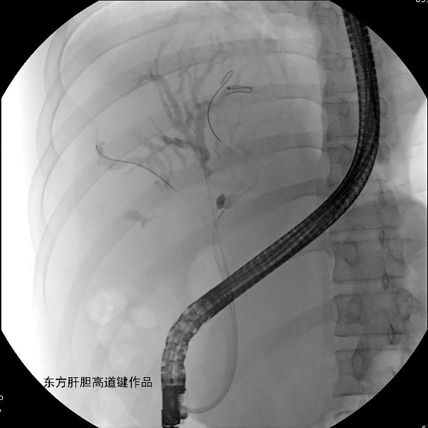 胆管支架什么样子内镜下三金属支架置入术治疗肝门胆管恶性狭窄_https://www.jmylbn.com_新闻资讯_第5张