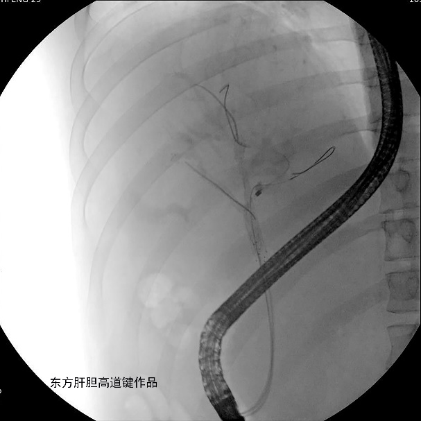 胆管支架什么样子内镜下三金属支架置入术治疗肝门胆管恶性狭窄_https://www.jmylbn.com_新闻资讯_第9张
