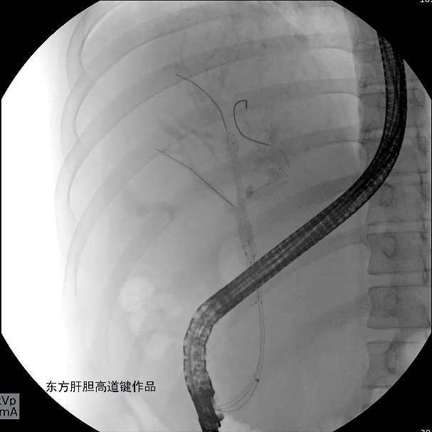 胆管支架什么样子内镜下三金属支架置入术治疗肝门胆管恶性狭窄_https://www.jmylbn.com_新闻资讯_第10张