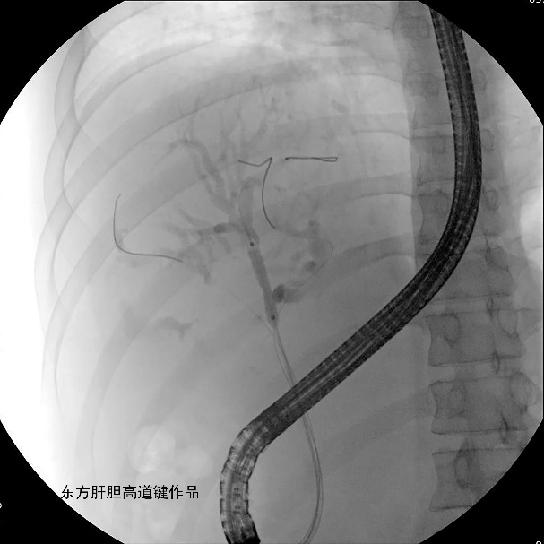 胆管支架什么样子内镜下三金属支架置入术治疗肝门胆管恶性狭窄_https://www.jmylbn.com_新闻资讯_第6张