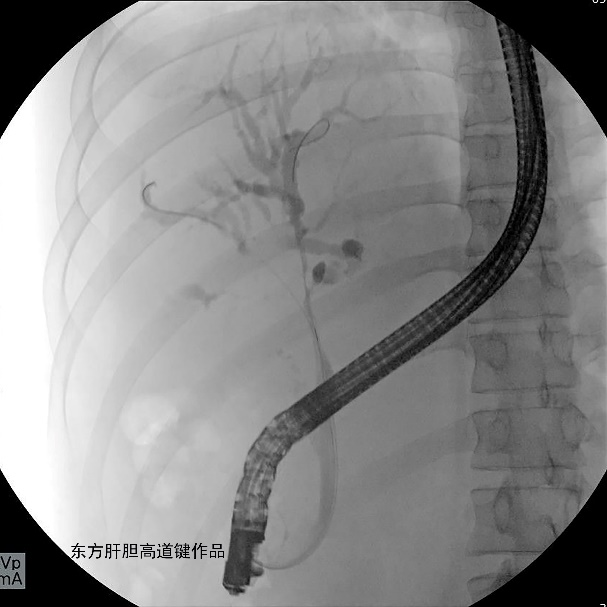 胆管支架什么样子内镜下三金属支架置入术治疗肝门胆管恶性狭窄_https://www.jmylbn.com_新闻资讯_第4张