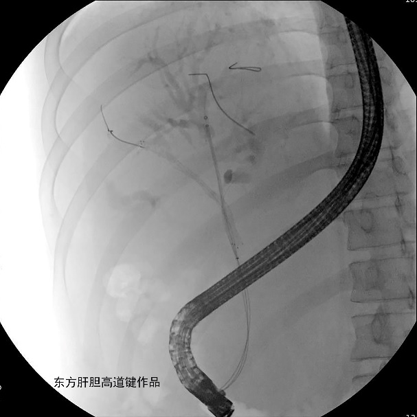 胆管支架什么样子内镜下三金属支架置入术治疗肝门胆管恶性狭窄_https://www.jmylbn.com_新闻资讯_第7张