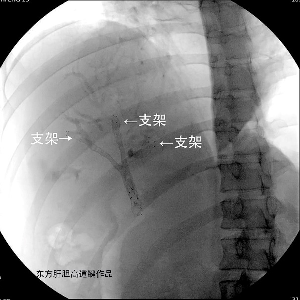 胆管支架什么样子内镜下三金属支架置入术治疗肝门胆管恶性狭窄_https://www.jmylbn.com_新闻资讯_第11张