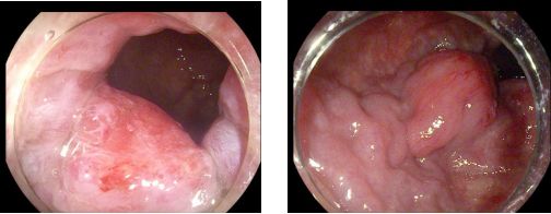 痔疮套扎吻合器怎么用内痔超级微创疗法——经内镜痔上直肠黏膜套扎术_https://www.jmylbn.com_新闻资讯_第5张