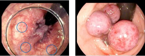 痔疮套扎吻合器怎么用内痔超级微创疗法——经内镜痔上直肠黏膜套扎术_https://www.jmylbn.com_新闻资讯_第8张