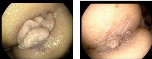 痔疮套扎吻合器怎么用内痔超级微创疗法——经内镜痔上直肠黏膜套扎术_https://www.jmylbn.com_新闻资讯_第9张