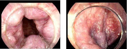 痔疮套扎吻合器怎么用内痔超级微创疗法——经内镜痔上直肠黏膜套扎术_https://www.jmylbn.com_新闻资讯_第4张