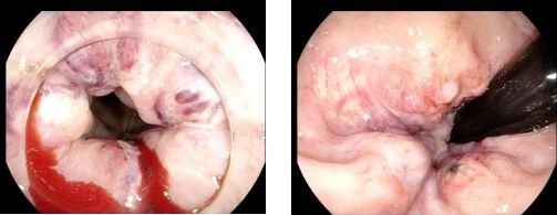 痔疮套扎吻合器怎么用内痔超级微创疗法——经内镜痔上直肠黏膜套扎术_https://www.jmylbn.com_新闻资讯_第6张