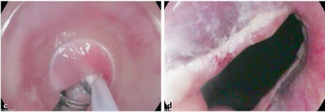 套扎环怎么下多环套扎黏膜切除用于难治性胃食管反流_https://www.jmylbn.com_新闻资讯_第4张