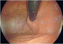 套扎环怎么下多环套扎黏膜切除用于难治性胃食管反流_https://www.jmylbn.com_新闻资讯_第5张