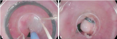套扎环怎么下多环套扎黏膜切除用于难治性胃食管反流_https://www.jmylbn.com_新闻资讯_第3张