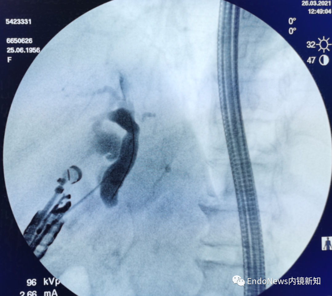 取石网篮 为什么贵EUS-BD操作中的细节：导丝如何超选？_https://www.jmylbn.com_新闻资讯_第3张