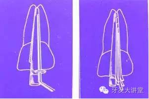 牙胶尖什么颜色【牙医知识】十本根管治疗相关的书，这一篇文章就能搞定！_https://www.jmylbn.com_新闻资讯_第14张