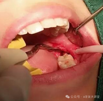 为什么牙医不用开口器【拔牙】的禁忌症，建议“所有牙医”收藏熟记！​_https://www.jmylbn.com_新闻资讯_第4张