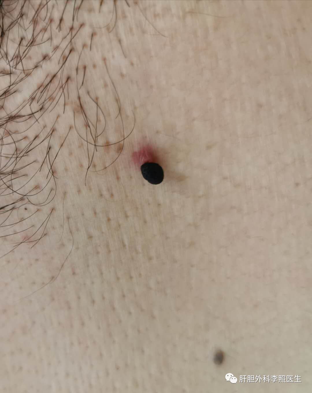 一种情况是淋巴结,一般多是浅表淋巴结,主要分布在颈部,腋窝,腹股沟等