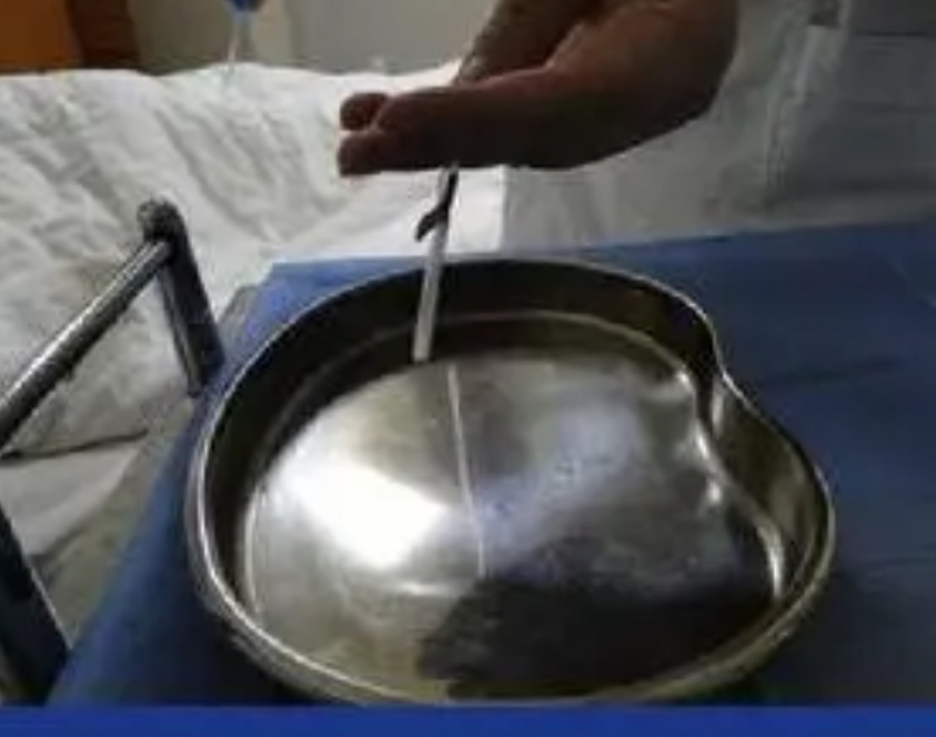 怎么调节输液器反折式负压静脉输液，包你成为一针大神，有图有真相_https://www.jmylbn.com_新闻资讯_第4张