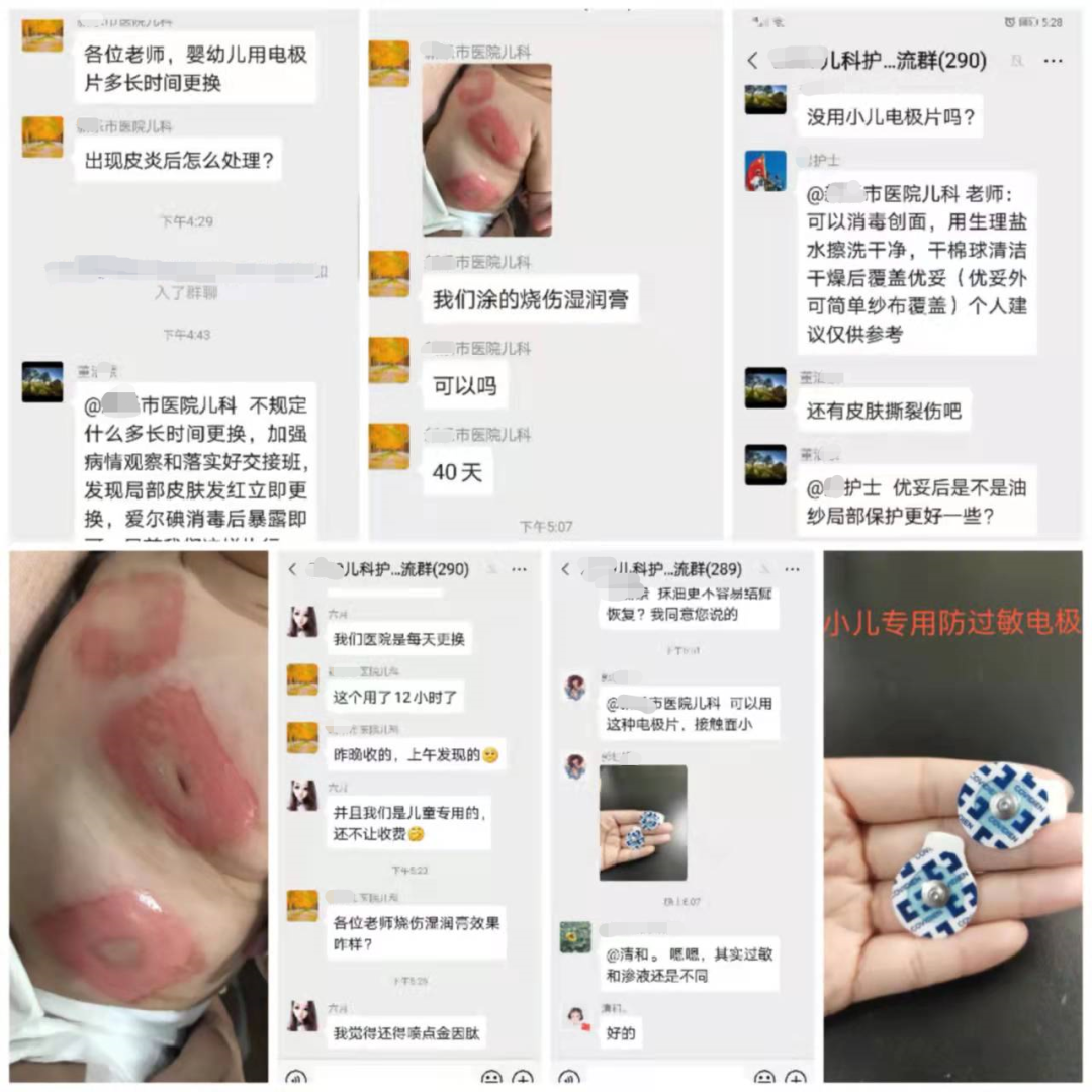 烧伤敷料怎么用图解患儿皮肤被电极片灼伤！看美小护这样处理！_https://www.jmylbn.com_新闻资讯_第2张