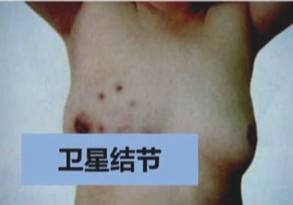 明确乳腺癌的临床表现 提高患者生存率 中国妇产科网