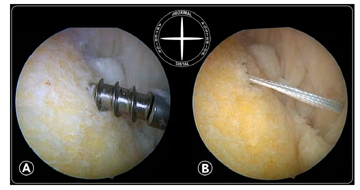 关节镜下锚钉跟腱加强zadek于1939年最先提出,跟骨楔形闭合截骨治疗