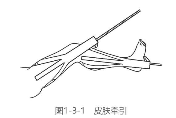 下肢皮肤牵引术步骤图图片