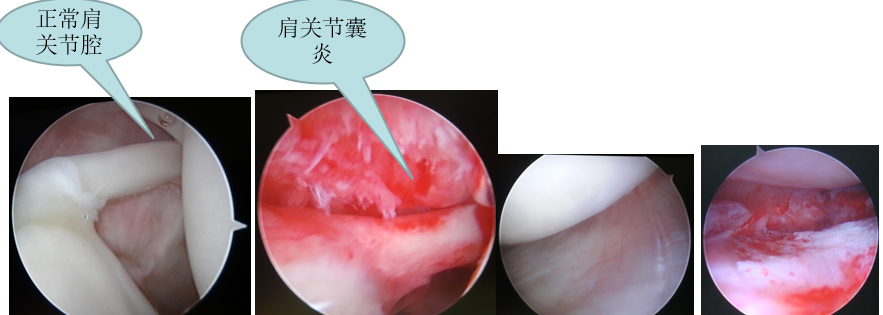 肩颈粘连图片图片