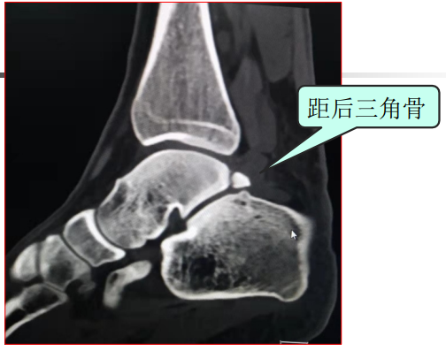 三角骨的位置图片图片